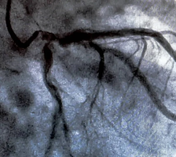 Cateterismo Ventriculografía Cardiaca Una Prueba Imagen Médica Utilizada Para Determinar — Foto de Stock