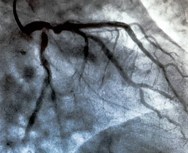 Cateterismo Ventriculografía Cardiaca Una Prueba Imagen Médica Utilizada Para Determinar — Foto de Stock