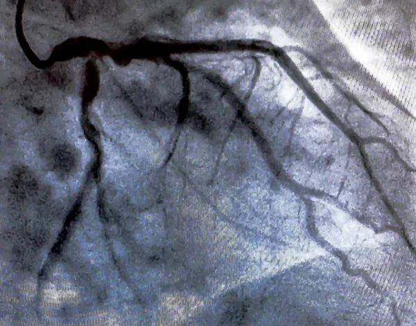 Catheterization. Cardiac ventriculography is a medical imaging test used to determine a patient cardiac function in the right or left ventricle