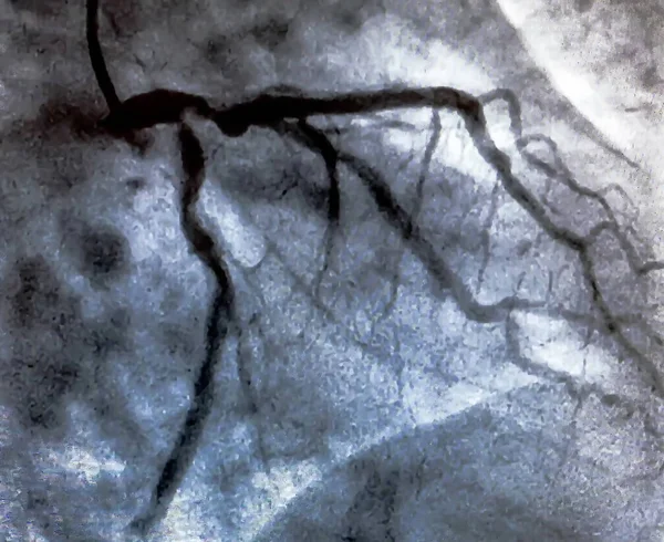 Cateterismo Ventriculografía Cardiaca Una Prueba Imagen Médica Utilizada Para Determinar —  Fotos de Stock