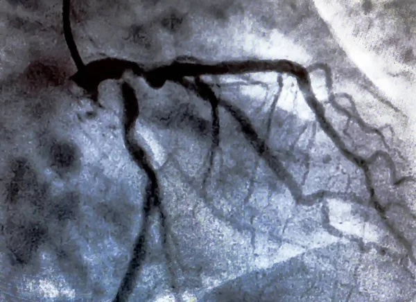 Катетеризація Серцевий Шлуночок Медичний Тест Який Використовується Визначення Функції Серця — стокове фото