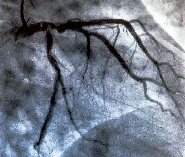 心脏导管置换术时左冠状动脉冠脉造影 大教堂化 心室造影 Cardiac Ventriculography 是一种用于确定病人心脏功能的医学影像检查 — 图库照片