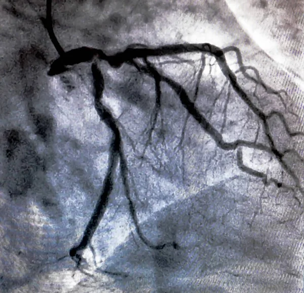 心臓カテーテル検査中に左冠動脈の冠動脈血管造影 カテテレーション 心室細動は 患者の心臓機能を決定するために使用される医療用画像検査です — ストック写真
