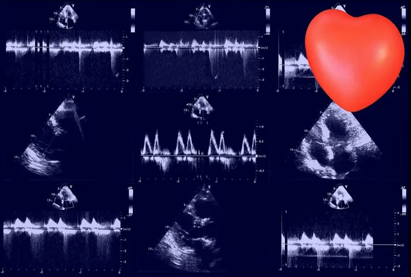 Cardiac ultrasound images and small heart . Screen of echo-cardiography machine. Doppler echo