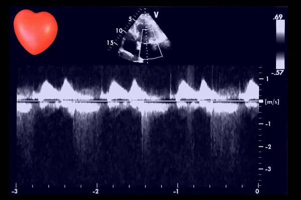 Kardiyak Ultrason Resimleri Küçük Kalp Yankı Cardiography Makinenin Ekran Doppler — Stok fotoğraf