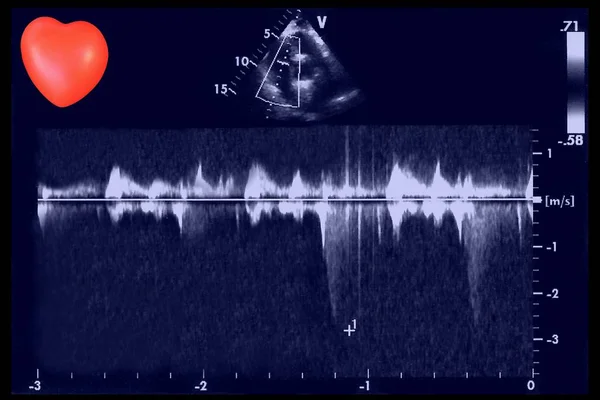 心脏超声图像和小心脏 心电图机的屏幕 多普勒回波 — 图库照片