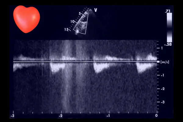 心脏超声图像和小心脏 心电图机的屏幕 多普勒回波 — 图库照片