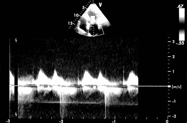 Εικόνες Υπερήχων Καρδιάς Οθόνη Του Echo Cardiography Μηχανή Doppler Echo — Φωτογραφία Αρχείου