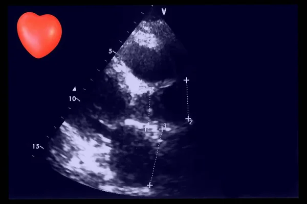 Cardiac Ultrasound Images Small Heart Screen Echo Cardiography Machine Doppler — Stock Photo, Image