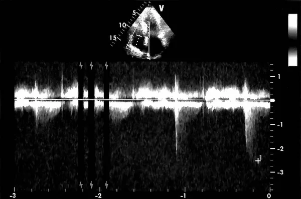 Εικόνες Υπερήχων Καρδιάς Οθόνη Του Echo Cardiography Μηχανή Doppler Echo — Φωτογραφία Αρχείου