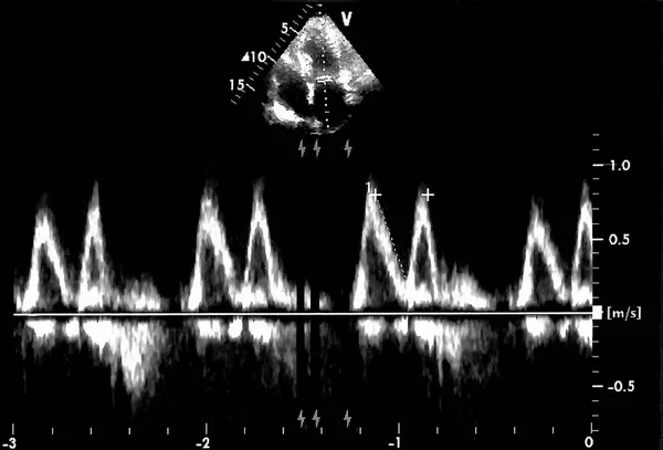 Obrazów Usg Serca Ekranie Echa Impedancyjna Maszyny Doppler Echo — Zdjęcie stockowe