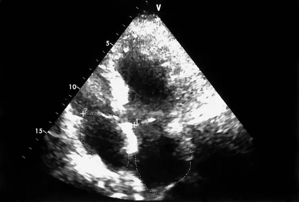 超音波心臓断層像 心エコーの機械の画面 ドップラー エコー — ストック写真