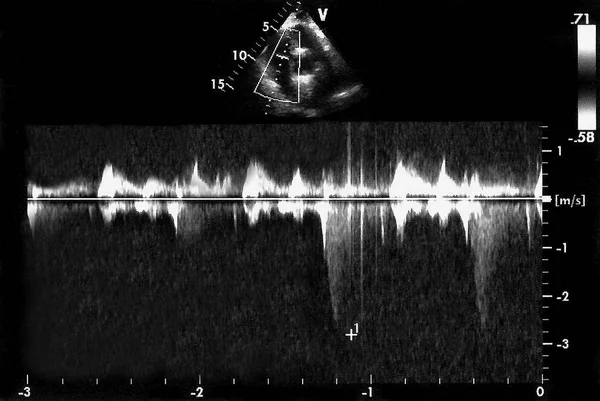 心脏超声图像 心电图机的屏幕 多普勒回波 — 图库照片