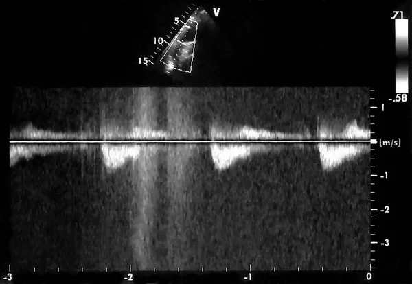 Kardiyak Ultrason Resimleri Yankı Cardiography Makinenin Ekran Doppler Yankı — Stok fotoğraf