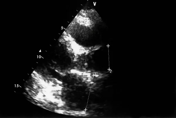 Kardiológiai Ultrahang Kép Képernyő Echo Cardiography Gép Echo Doppler — Stock Fotó