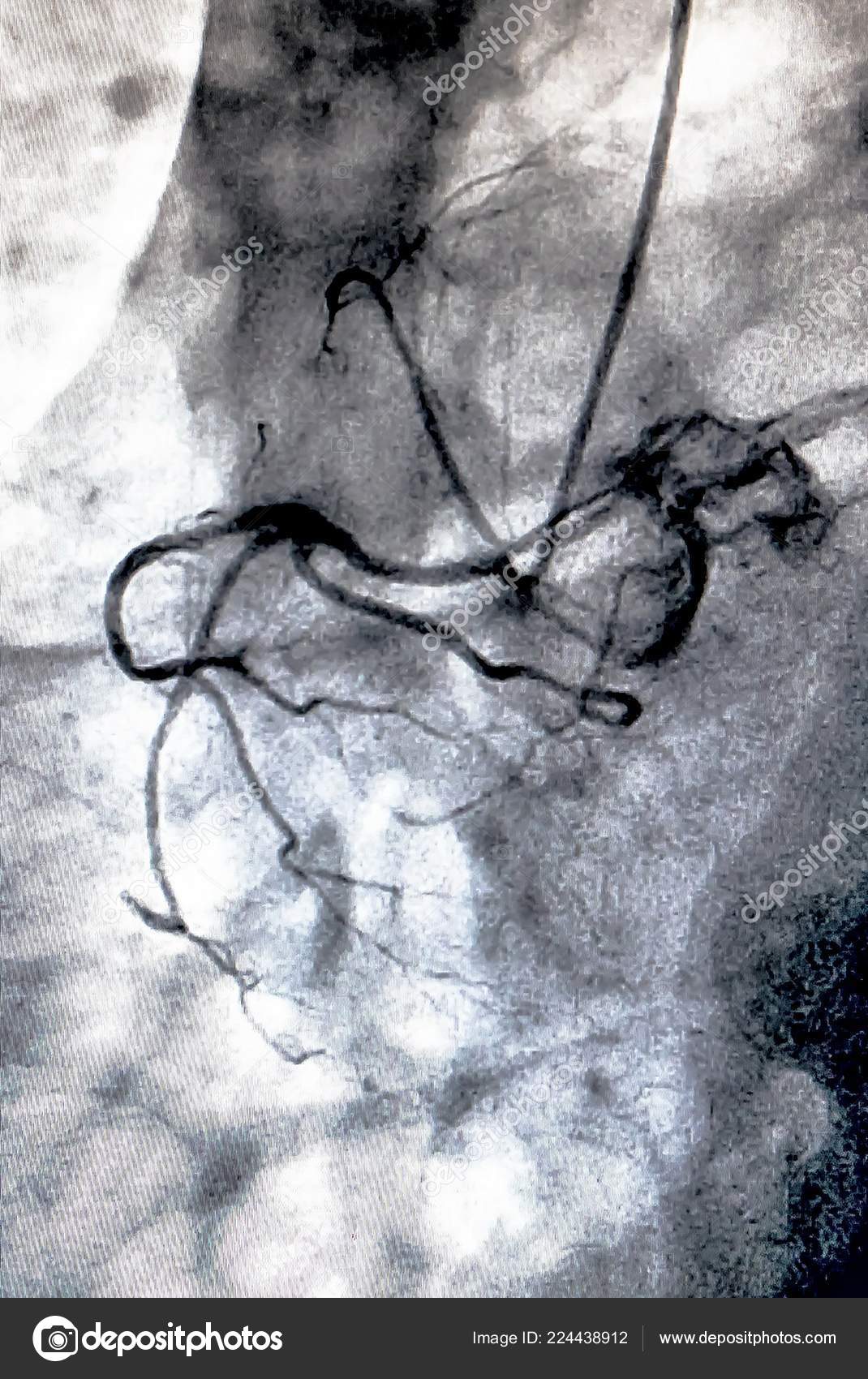 Catheterization Cardiac Ventriculography Medical Imaging Test Used