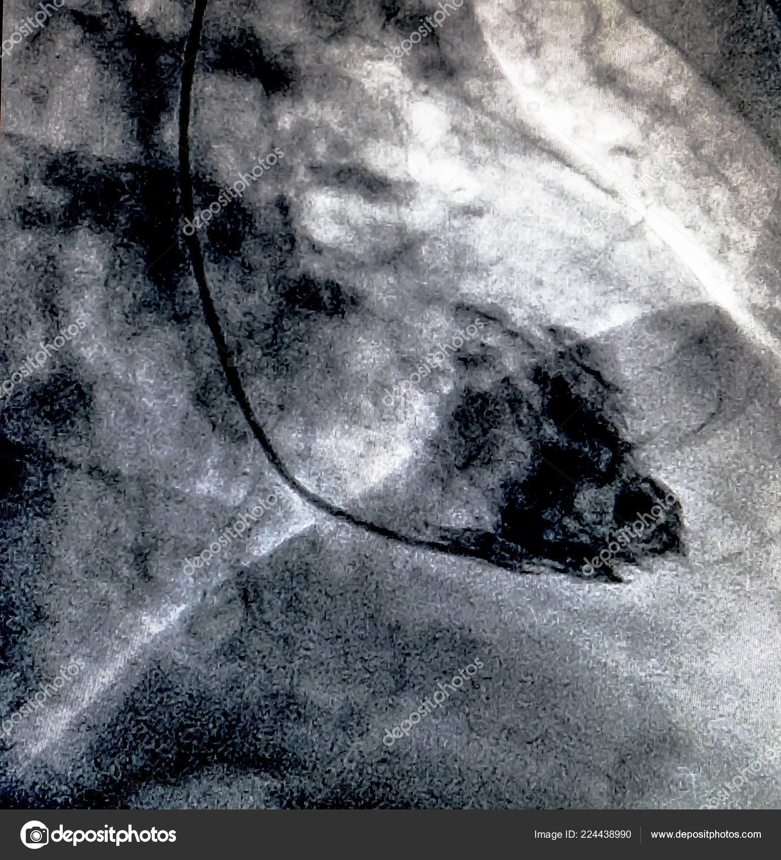 Catheterization Cardiac Ventriculography Medical Imaging Test Used