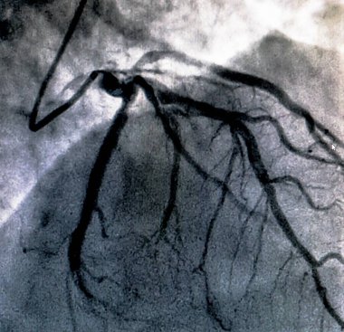 Kalp kateterizasyonu sırasında sol koroner arterin koroner arter anjiyogramı. Kateterizasyon. Kardiyak ventrikülografi hastanın kalp fonksiyonlarını belirlemek için kullanılan tıbbi bir görüntüleme testidir.