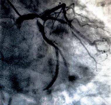 Kateterizasyon. Kardiyak ventrikülografi sağ veya sol ventrikül bir hasta kardiyak işlev belirlemek için kullanılan bir tıbbi görüntüleme testtir