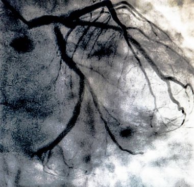 Kateterizasyon. Kardiyak ventrikülografi sağ veya sol ventrikül bir hasta kardiyak işlev belirlemek için kullanılan bir tıbbi görüntüleme testtir