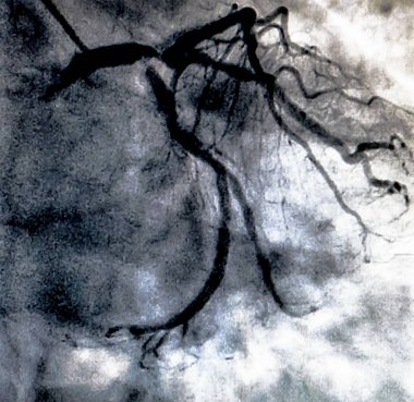 Kalp kateterizasyonu sırasında sol koroner arterin koroner arter anjiyogramı. Kateterizasyon. Kardiyak ventrikülografi hastanın kalp fonksiyonlarını belirlemek için kullanılan tıbbi bir görüntüleme testidir.