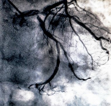 Kateterizasyon. Kardiyak ventrikülografi sağ veya sol ventrikül bir hasta kardiyak işlev belirlemek için kullanılan bir tıbbi görüntüleme testtir