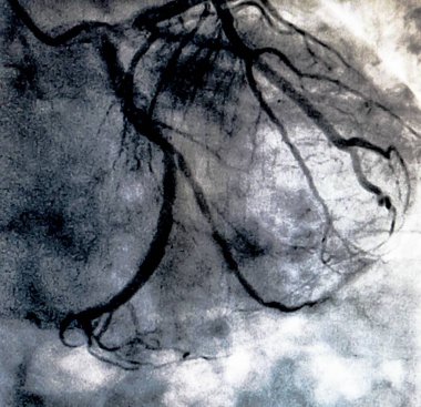 Kateterizasyon. Kardiyak ventrikülografi sağ veya sol ventrikül bir hasta kardiyak işlev belirlemek için kullanılan bir tıbbi görüntüleme testtir