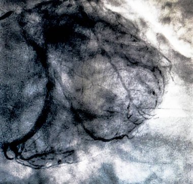 Kateterizasyon. Kardiyak ventrikülografi sağ veya sol ventrikül bir hasta kardiyak işlev belirlemek için kullanılan bir tıbbi görüntüleme testtir