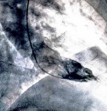 Kateterizasyon. Kardiyak ventrikülografi sağ veya sol ventrikül bir hasta kardiyak işlev belirlemek için kullanılan bir tıbbi görüntüleme testtir