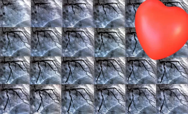 Cateterizzazione Piccolo Cuore Rosso Ventricolografia Cardiaca Test Imaging Medico Utilizzato — Foto Stock