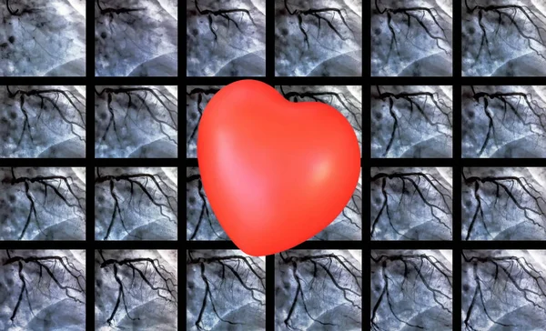 カテーテル検査と小さな赤いハート 心臓造影は右または左心室における患者の心機能を決定するために使用するイメージング検査です — ストック写真