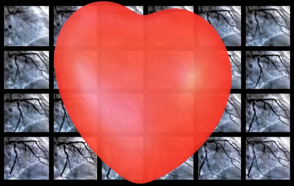 Катетеризация Маленькое Красное Сердце Сердечный Желудочек Медицинский Томограф Используемый Определения — стоковое фото