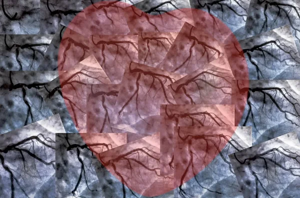 Katheterisierung Und Kleines Rotes Herz Die Herzventrikulographie Ist Ein Bildgebender — Stockfoto