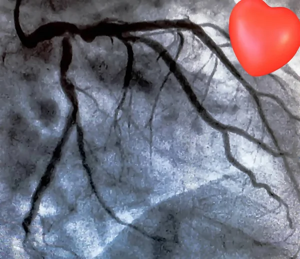 Kalp Kateterizasyonu Sırasında Sol Koroner Arterin Koroner Arter Anjiyogramı Kateterizasyon — Stok fotoğraf