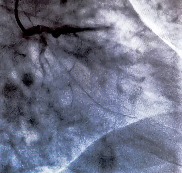 Catheterisatie Cardiale Ventriculography Een Medische Beeldvorming Test Gebruikt Bepalen Een — Stockfoto