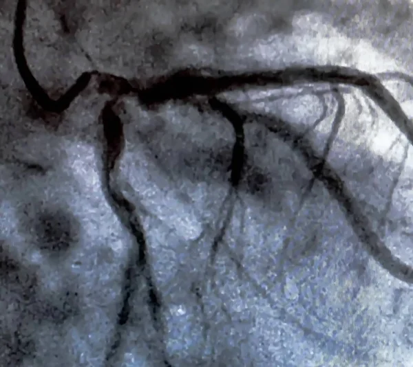 Cateterismo Ventriculografia Cardíaca Exame Imagem Médica Usado Para Determinar Função — Fotografia de Stock