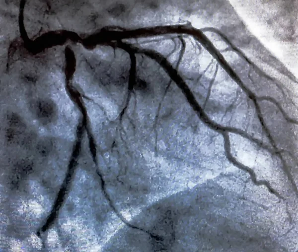 Kateterisering Hjertekulografi Medisinsk Billeddiagnostikk Som Brukes Til Bestemme Pasients Hjertefunksjon – stockfoto