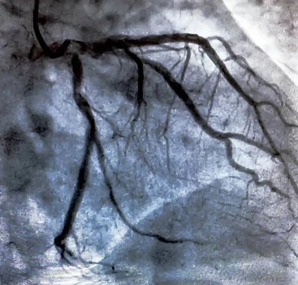 Kateterisering Hjertekulografi Medisinsk Billeddiagnostikk Som Brukes Til Bestemme Pasients Hjertefunksjon – stockfoto