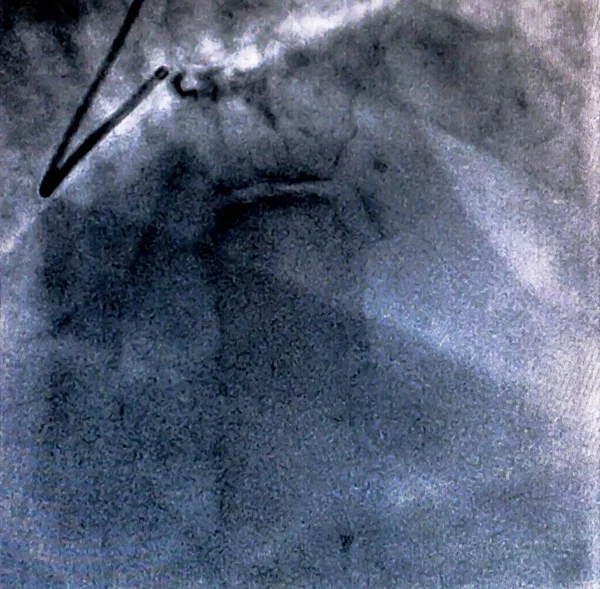 Catheterisatie Cardiale Ventriculography Een Medische Beeldvorming Test Gebruikt Bepalen Een — Stockfoto