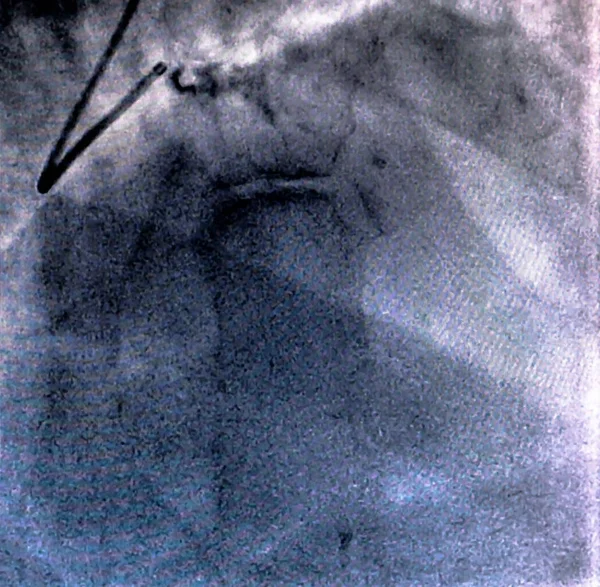 Cateterismo Ventriculografía Cardiaca Una Prueba Imagen Médica Utilizada Para Determinar — Foto de Stock