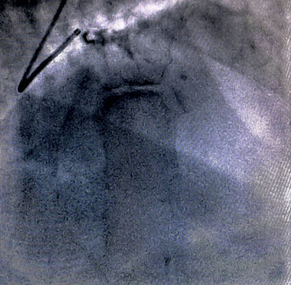 Catheterization Cardiac Ventriculography Medical Imaging Test Used Determine Patient Cardiac — Stock Photo, Image