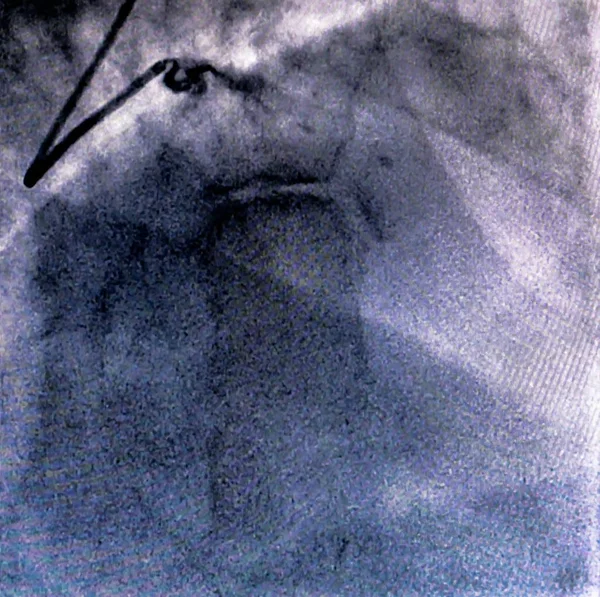 Catheterization Cardiac Ventriculography Medical Imaging Test Used