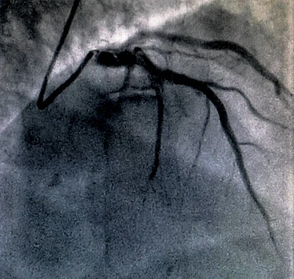 Catheterization Cardiac Ventriculography Medical Imaging Test Used