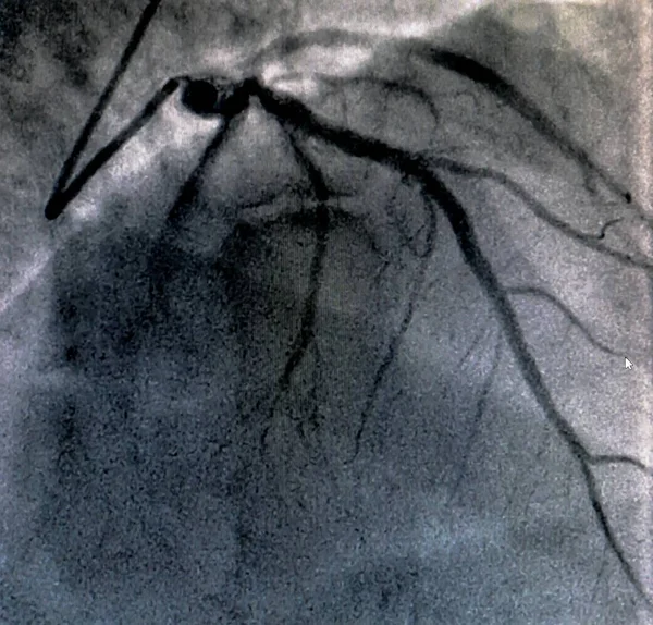 Kalp Kateterizasyonu Sırasında Sol Koroner Arterin Koroner Arter Anjiyogramı Kateterizasyon — Stok fotoğraf