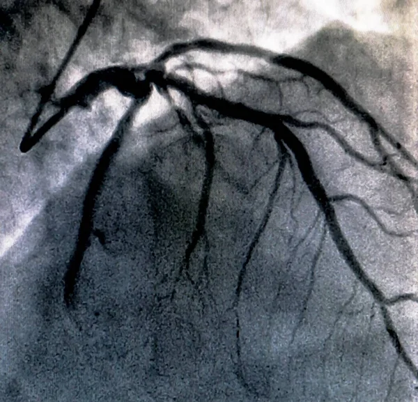 Cateterismo Ventriculografía Cardiaca Una Prueba Imagen Médica Utilizada Para Determinar —  Fotos de Stock