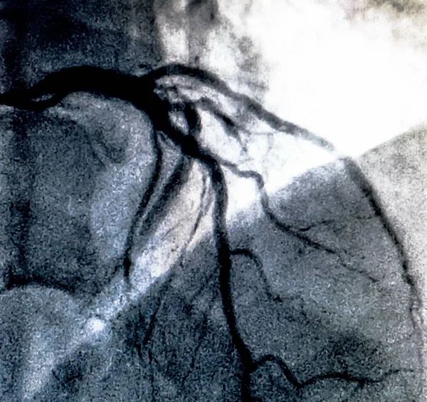 Cateterismo Ventriculografía Cardiaca Una Prueba Imagen Médica Utilizada Para Determinar —  Fotos de Stock