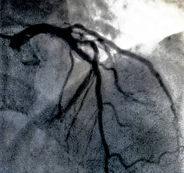 Catheterization Cardiac Ventriculography Medical Imaging Test Used Determine Patient Cardiac — Stock Photo, Image