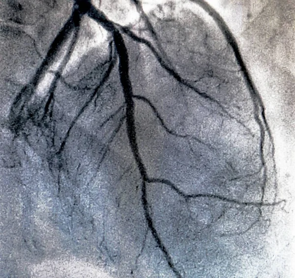 カテーテル検査 心臓造影は右または左心室における患者の心機能を決定するために使用するイメージング検査です — ストック写真