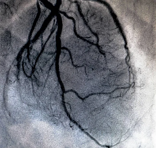 Cateterismo Ventriculografía Cardiaca Una Prueba Imagen Médica Utilizada Para Determinar — Foto de Stock