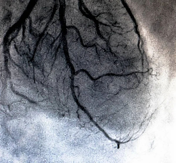 Cateterismo Ventriculografía Cardiaca Una Prueba Imagen Médica Utilizada Para Determinar —  Fotos de Stock